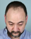 Before Hair Transplant&nbsp;Front